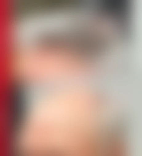 Resultado de prótese capilar Verdugo