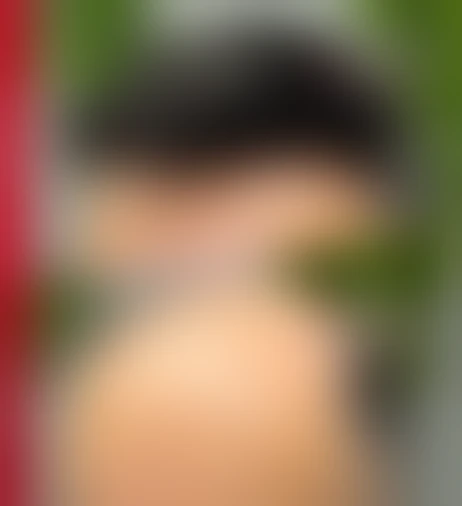 Resultado de prótese capilar Verdugo