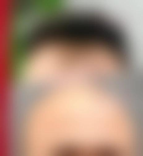 Resultado de prótese capilar Verdugo