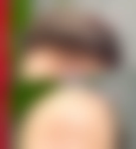 Resultado de prótese capilar Verdugo