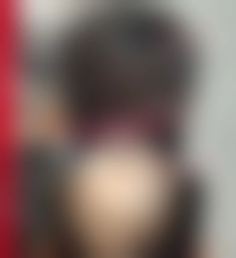 Resultado de prótese capilar Verdugo