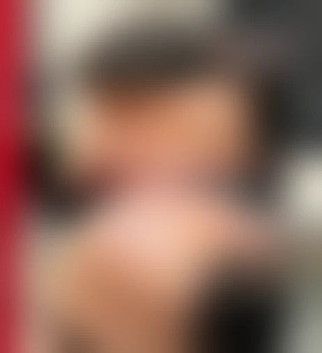Resultado de prótese capilar Verdugo