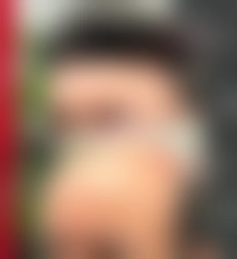 Resultado de prótese capilar Verdugo