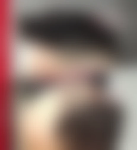 Resultado de prótese capilar Verdugo