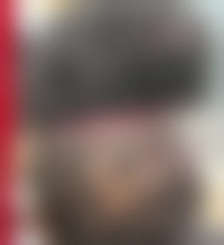 Resultado de prótese capilar Verdugo